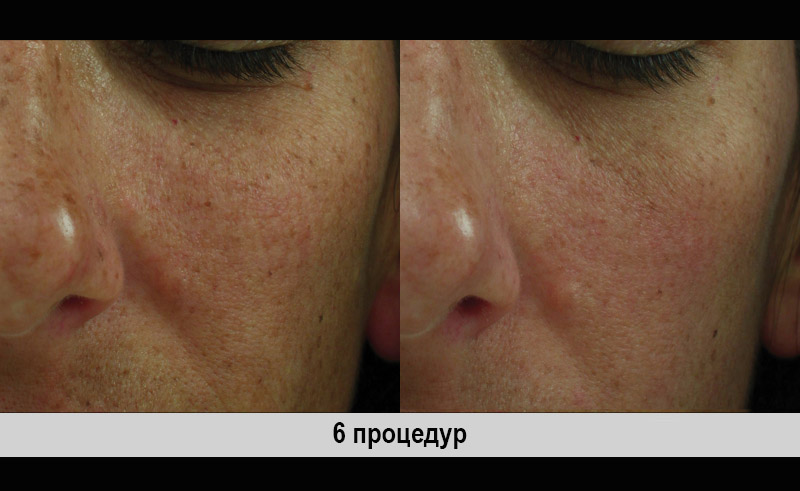 Clear&Brilliant. Результаты до и после